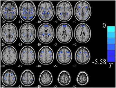 Abnormal voxel-mirrored homotopic connectivity in first-episode major depressive disorder using fMRI: a machine learning approach